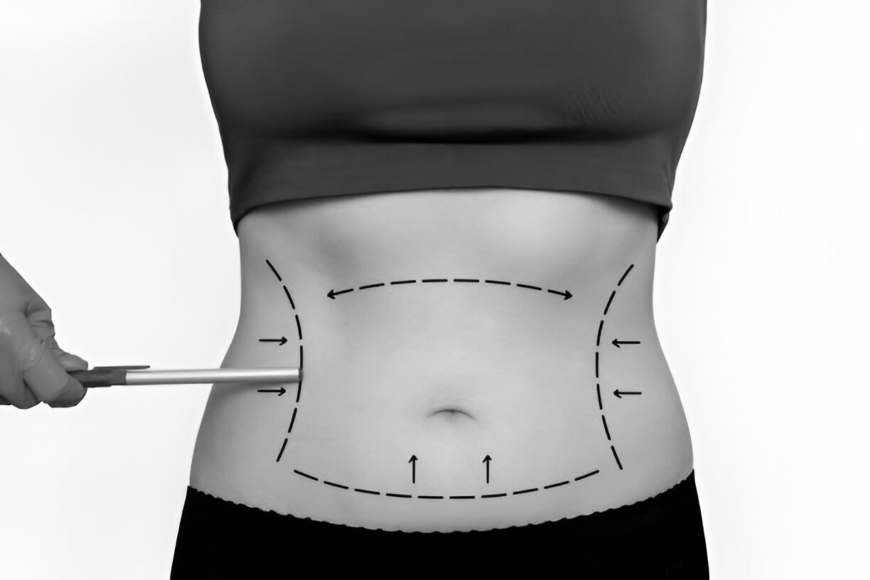 what are the benefits of Vaser liposuction