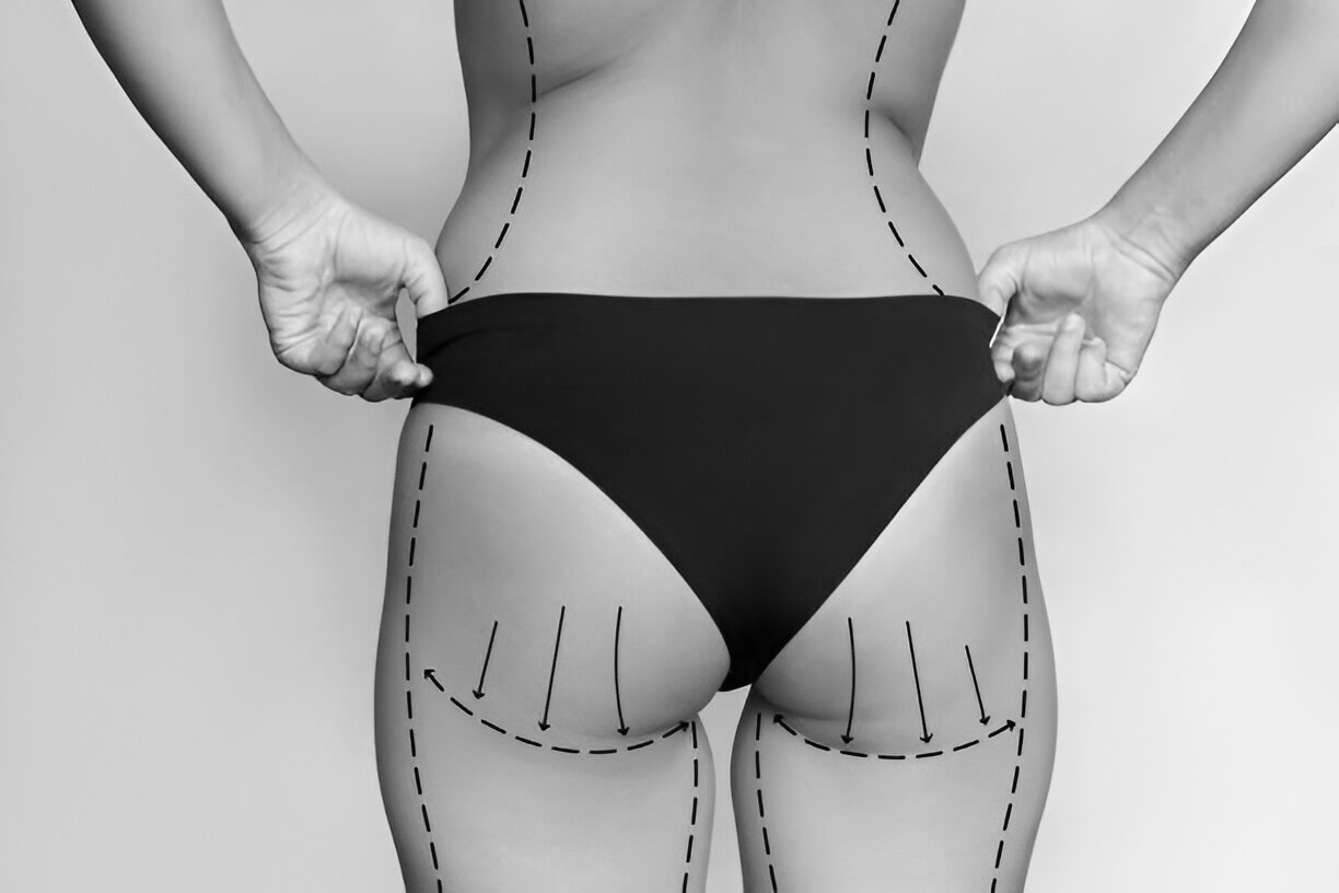what does bbl surgery mean