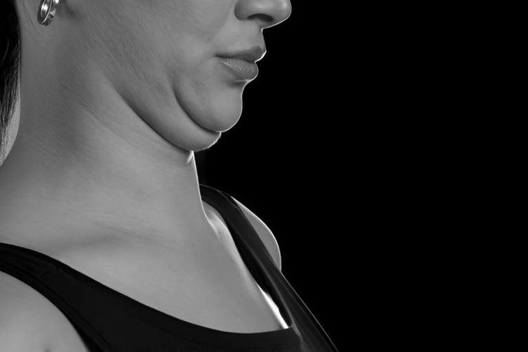 How to Get Rid of Double Chin?