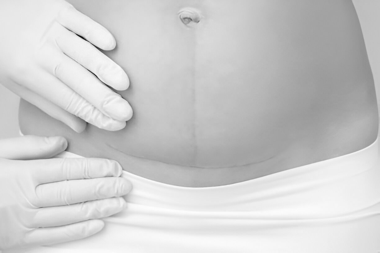 tummy tuck scars after 2 years pictures