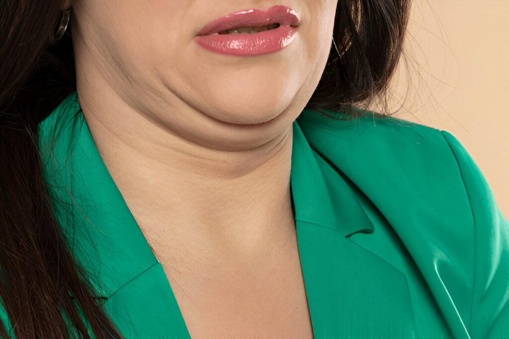 Chin Liposuction