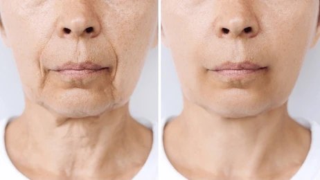 skin tightening treatment