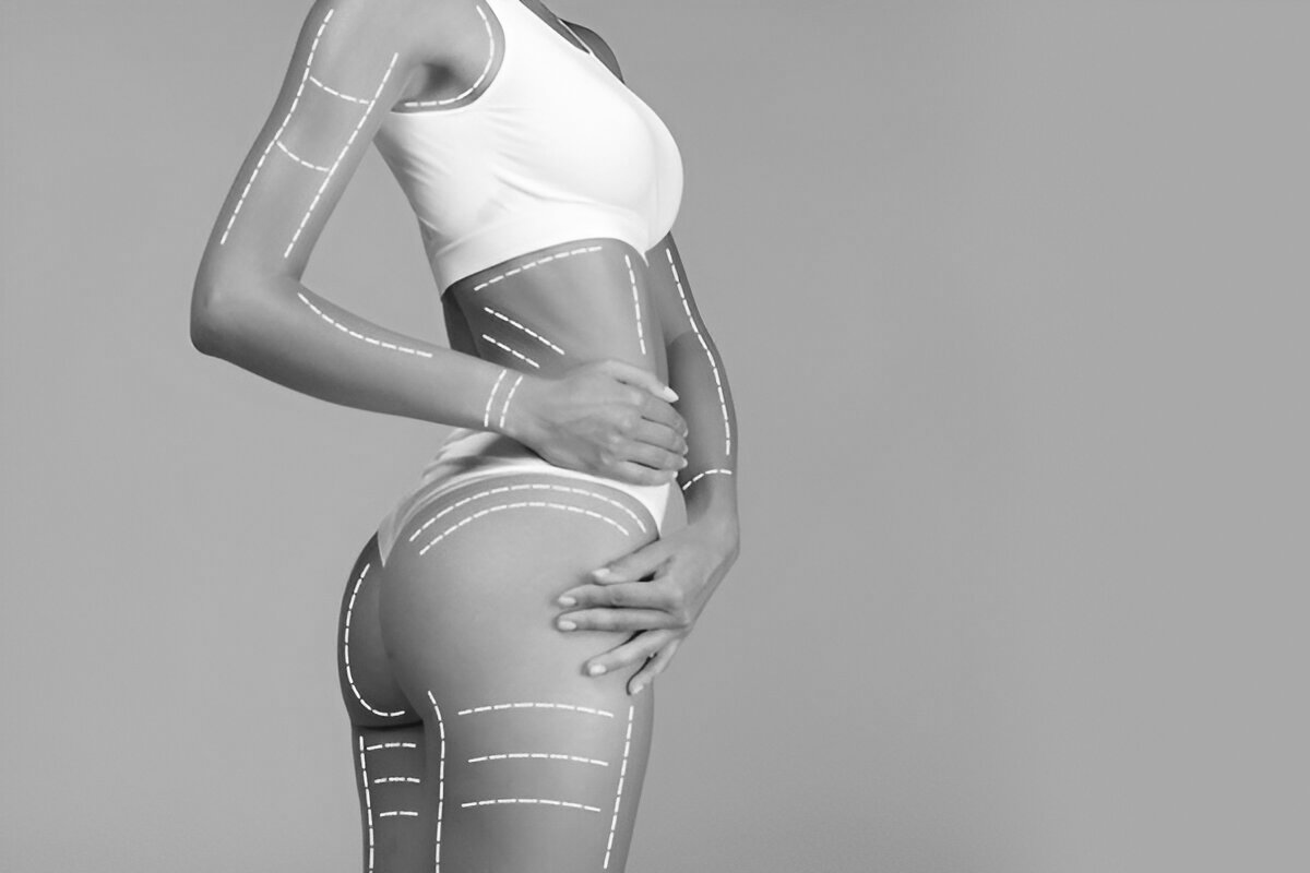 bbl butt lift