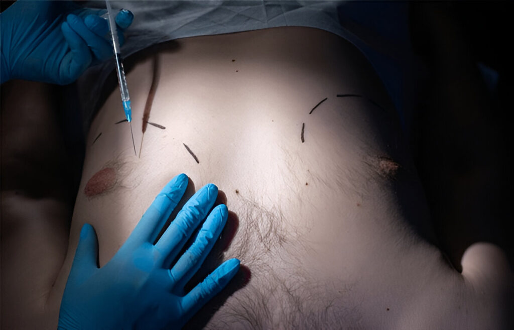 man boobs removal