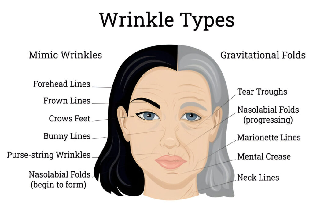 types of wrinkle