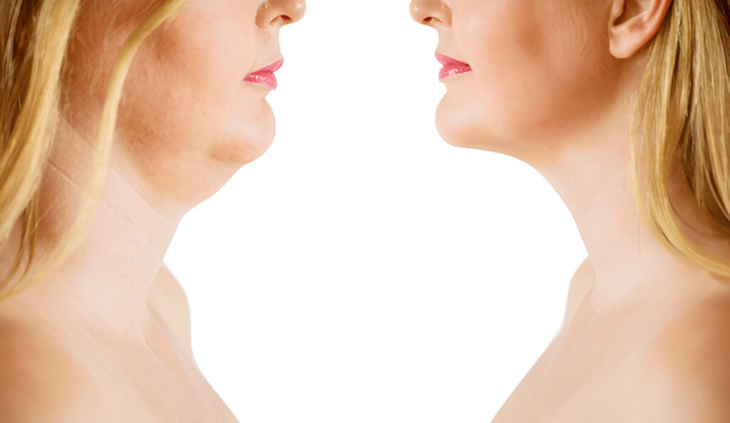 Double Chin Removal