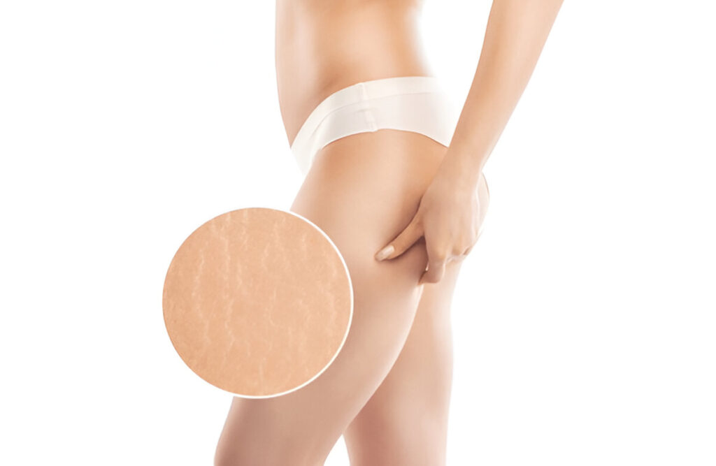 how to get rid of stretch marks on thighs