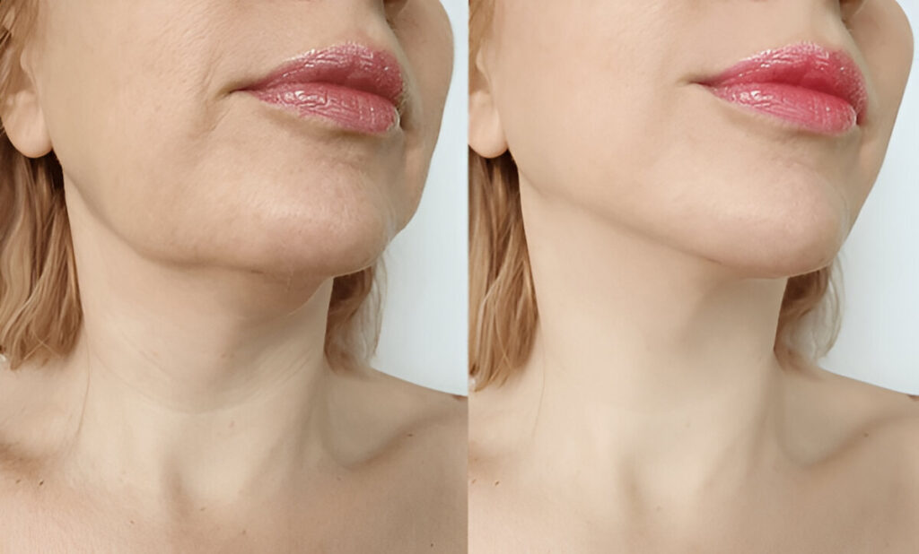 How to Lose Face Fat in a Week