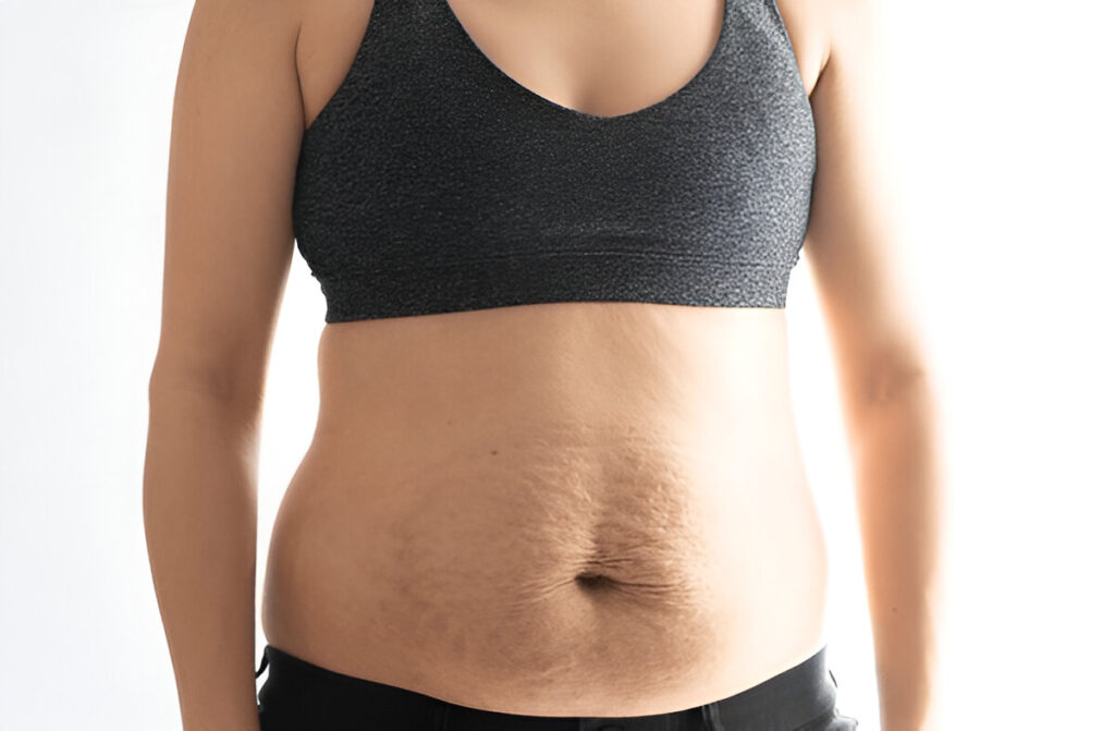 How to get rid of stretch marks?