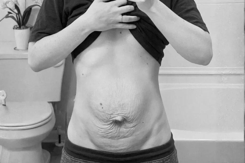 diastasis recti