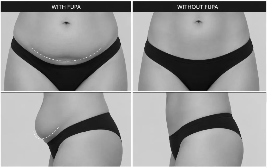 What is FUPA & How to get rid of it