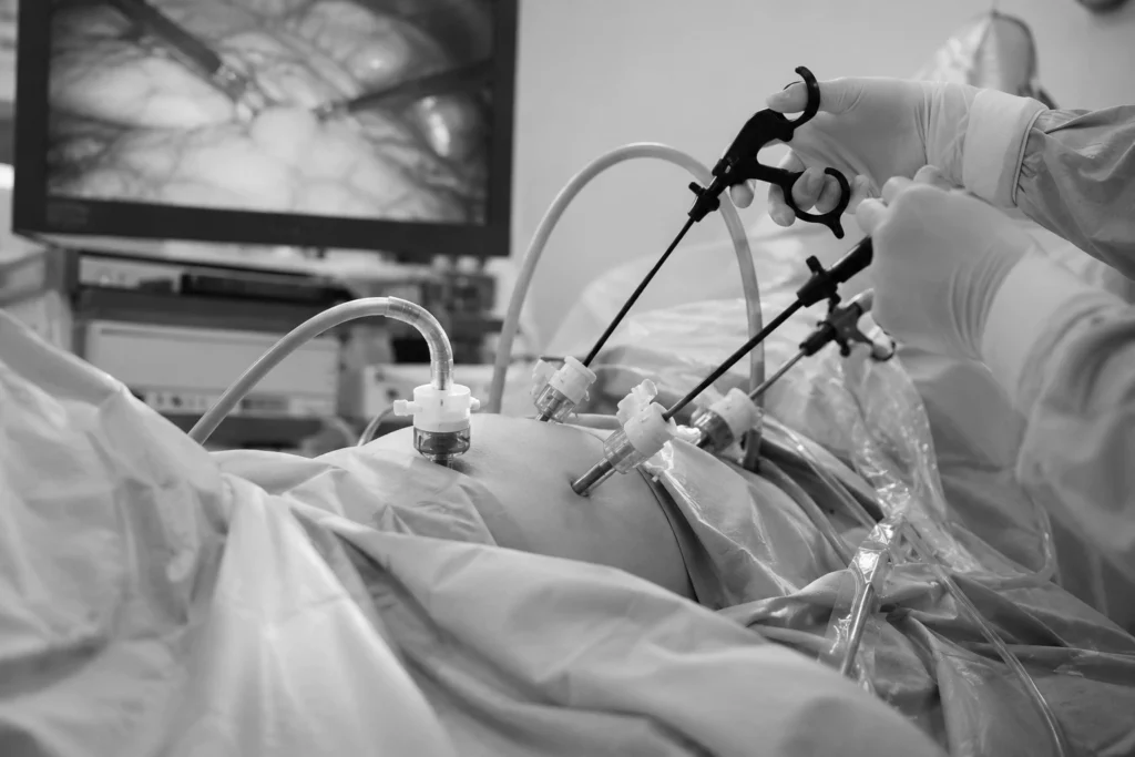 Bariatric Surgery